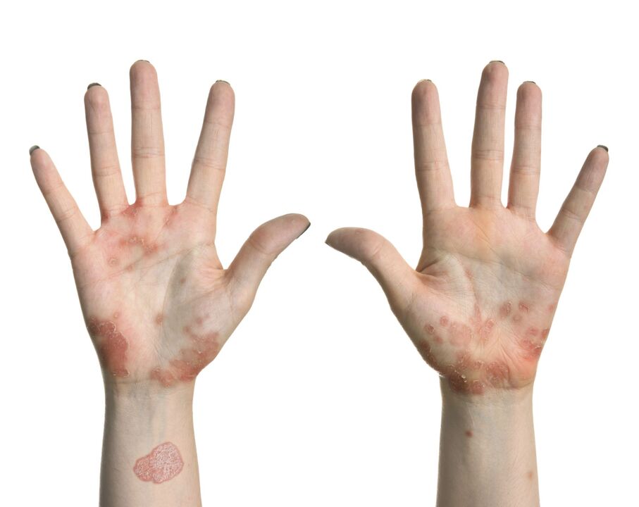 Psoriasis sur les mains